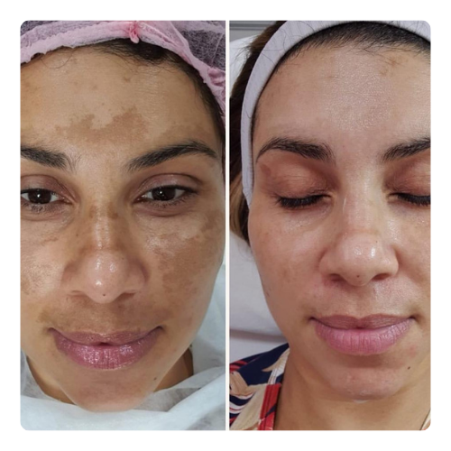 Tratamento de Melasma